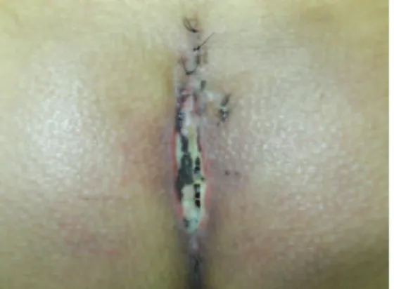 Figura 5 – Incidência de complicações em gluteoplastia de  aumento com implantes intramusculares