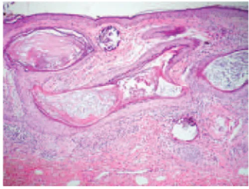 Figura 8 – Aspecto anatomopatológico: múltiplos cistos revestidos  por epitélio estratiicado corneiicado, sem atipias, 
