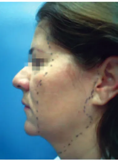 Figura 2 – Paciente de peril, com demarcação cutânea delimitada  na área de dissecção da região temporal, em toda a face, desde 