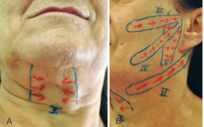 Figura 1 – Em A, demarcação do vetor I, para tratamento  do platisma na região médio-cervical, mediante duas linhas  verticais e paralelas sobre as bridas, mesmo quando única