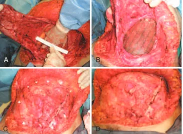 Figura 3 – Em A, defeito da parede abdominal.  