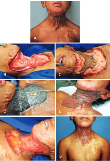 Figura 1 – Criança com contratura cicatricial em região cervical  decorrente de queimadura prévia, apresentando limitação para 