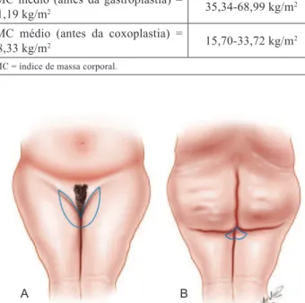 Figura 1 – Representação do traçado das incisões conforme a  técnica de Lockwood. Em A, vista anterior e em B, vista posterior.