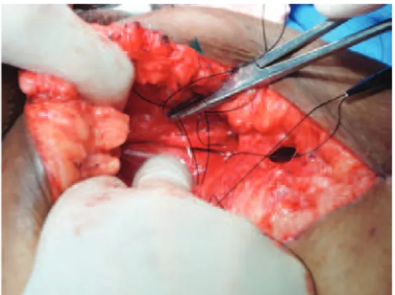 Figura 3 – Demarcação das incisões que compõem a área  falciforme, segundo a proposta de Lewis