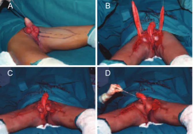 Figura 6 – Em A, reconstrução de bolsa escrotal com sutura direta  de tecidos remanescentes
