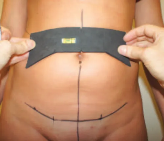 Figura 4 – Marcação realizada no período pré-operatório de  dermolipectomia abdominal, observando-se 3 segmentos de reta,  