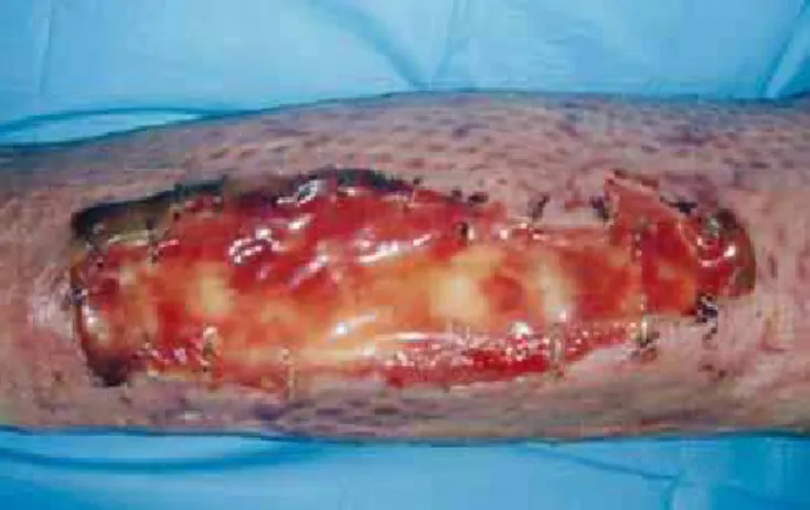 Figura 12 – Três semanas após aplicação de matriz de  regeneração dérmica na perna esquerda.