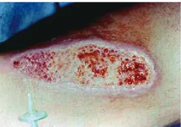 Figura 2  –  A: Úlcera crônica do membro inferior direito  com intenso depósito de ibrina e edema no leito do tecido de  granulação