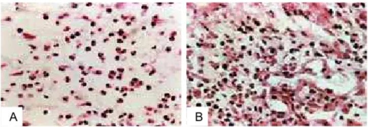 Figura 7  –  A: Edema do tecido de granulação promovendo  dispersão das células inflamatórias com predominância 
