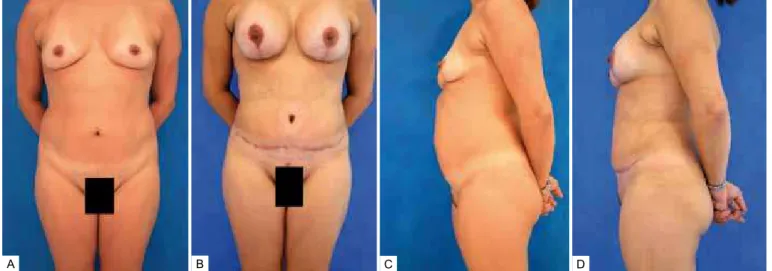 Figura 7 – Lipoabdominoplastia e mastopexia com colocação de prótese. A e C: pré-operatório; B e D: pós-operatório.