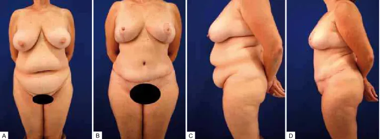 Figura 10  – Lipoabdominoplastia com redução de mamas . A e C:  pré-operatório;  B  e  D:  pós-operatório.