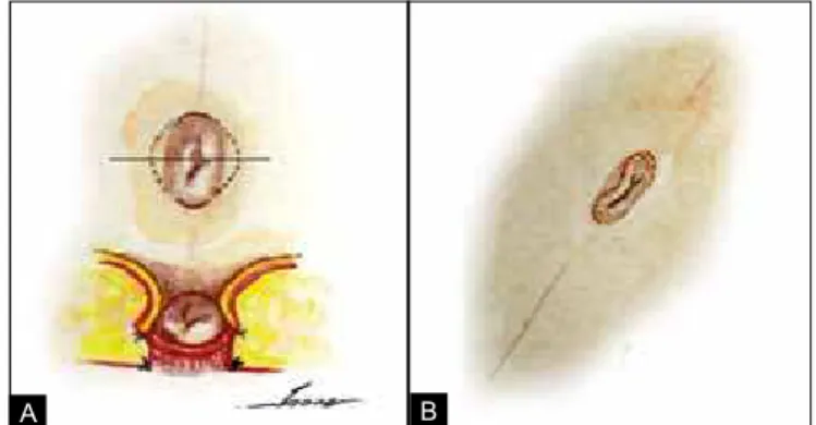 Figura 1  –  A:  Foto umbigo: vertical de 2,5 cm e horizontal de 1,5  cm. B: Ilha de pele do umbigo em losango, e após a ixação na 