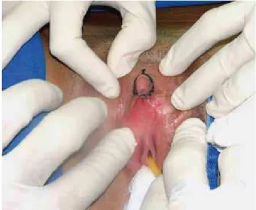 Figura 3 – Demarcação da incisão circular de acesso entre o  prepúcio e a glande do clitóris (paciente 1).