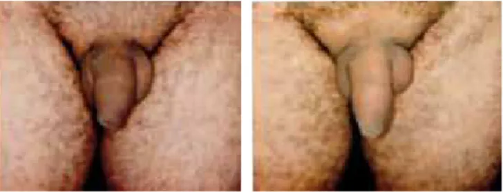 Figura 12 – Aspecto pré-operatório e de um ano de pós- pós-operatório, vista anterior e lateral de paciente com 30 anos de  idade submetido a injeção 80 cc de gordura no pênis numa única 