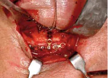 Figura 4 – Cartilagem autógena. Enxerto de cartilagem auricular  em assoalho e parede medial de órbita