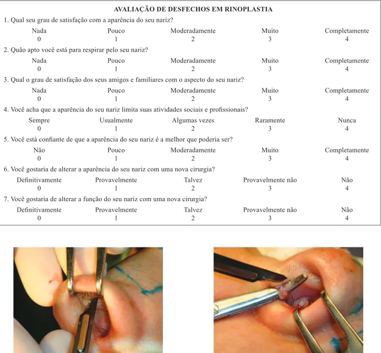 Figura 1 – Incisão transcartilaginosa. Figura 2 – Ressecção do músculo depressor do septo.