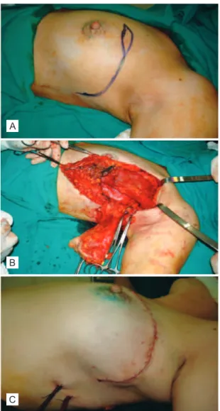 Figura 1 – Em A, demarcação da incisão cutânea para extirpar a  lesão em junção dos quadrantes superiores, com o prolongamento  no sentido craniocaudal para o acesso ao músculo latíssimo do  dorso