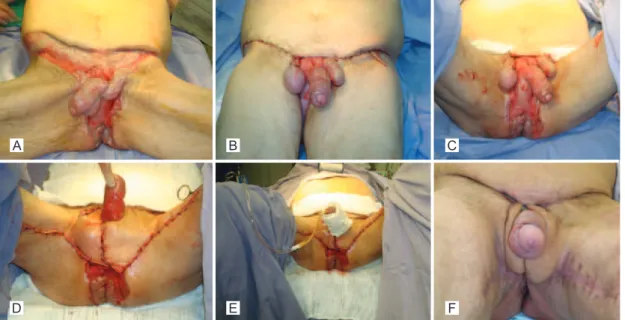 Figura 2 – Em A, pré-operatório de lesão de abdome, púbis e bolsa escrotal. Em B, paciente logo após sutura da fáscia abdominal  e sutura da pele e tecido gorduroso após pequeno descolamento