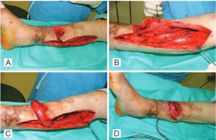 Figura 1 – Técnica cirúrgica. Em A, área da lesão desbridada   e incisão medial na perna para acesso ao músculo solear