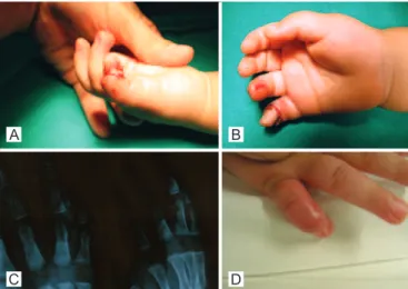 Figura 1 – Em A e B, amputação subtotal, sendo a continuidade  mantida apenas pelo lexor profundo do dedo