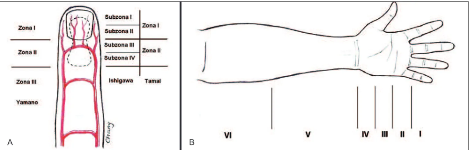 Figura 2 – Em A, esquema das zonas de reimplante de dedo, segundo a classiicação de Yamano, Ishigawa e Tamai, baseada no padrão  vascular
