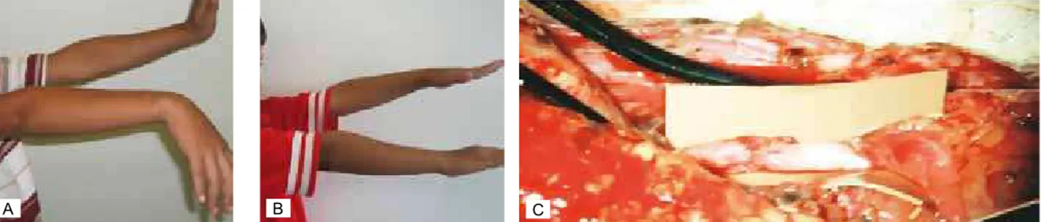 Figura 3 - Criança com lesão cortante do nervo radial no 1/3 distal do braço. A: pré-operatório; B: 6º mês de pós-operatório -  resultado M5; C: transoperatório; neurorraia epineural término-terminal.