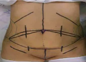 Figura 1 - Marcação prévia da abdominoplastia e neo-onfaloplastia.