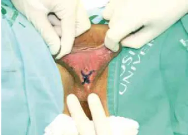 Figura 2 - Marcação dos retalhos medindo 12x6 cm. Base situada  a nível posterior do intróito vaginal e ápice próximo ao triângulo  femoral, metade situado na vulva e metade na raiz de coxa