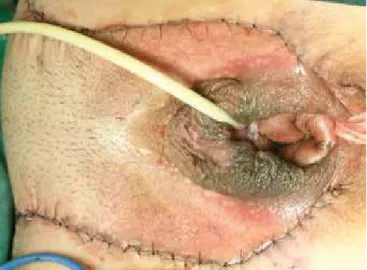 Figura 10 - Paciente no 40º dia de pós-operatório, apresentando  alargamento do terço médio da cicatriz bilateralmente