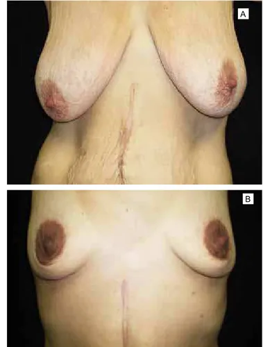 Figura 1 - A: lacidez do abdome; B: hérnia incisional.