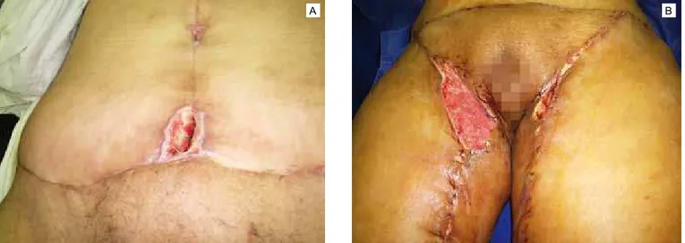 Figura 7 – A: necrose da extremidade do retalho abdominal; B: extensa deiscência de sutura em cruroplastia.