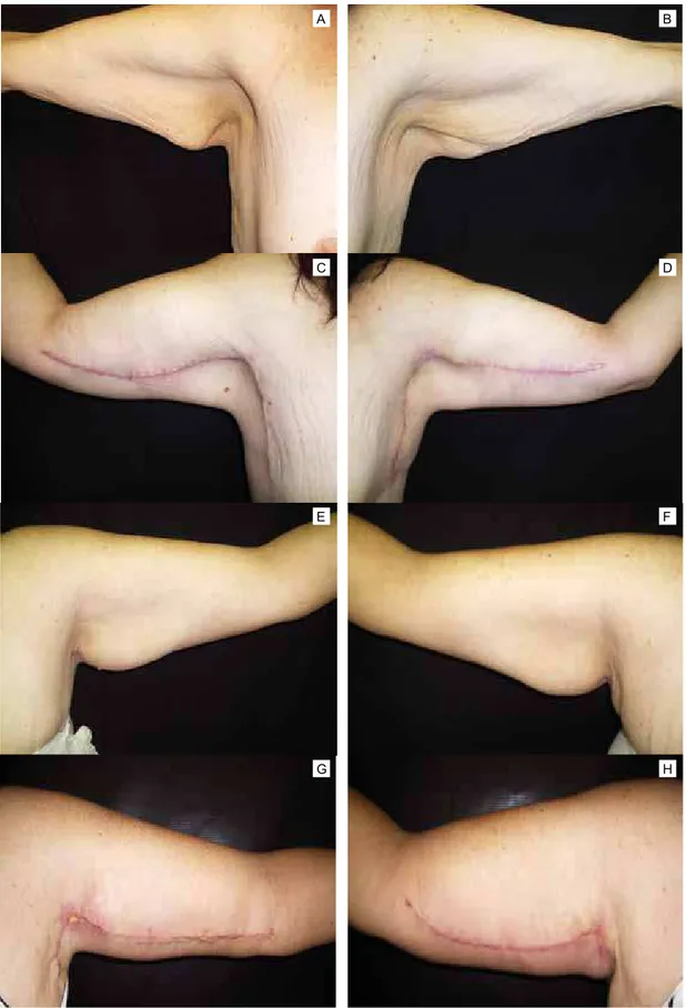 Figura 12 - A: braço direito, aspecto pré-operatório; B: braço esquerdo, aspecto pré-operatório; C: braço direito, aspecto pós-operatório; 