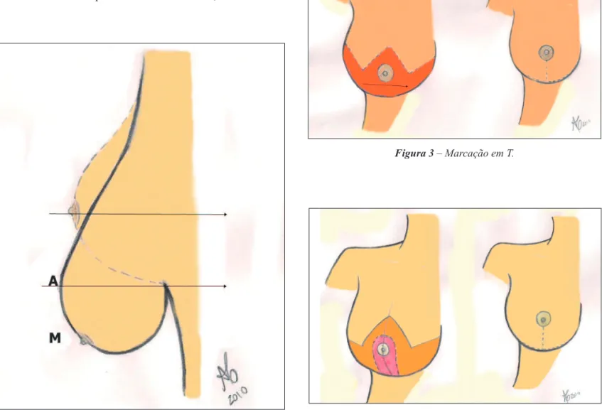 Figura 2 – Marcação em L.