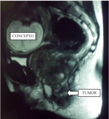 Figura 2. Ressonância nuclear magnética mostrando gravidez e  tumor de reto.