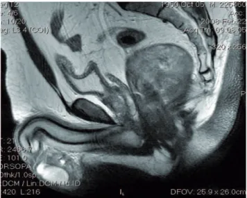 Figura  2.  Imagem  de  ressonância  nuclear  magnética  de  GIST  retal pós-neoadjuvância, com diminuição do tamanho do tumor.