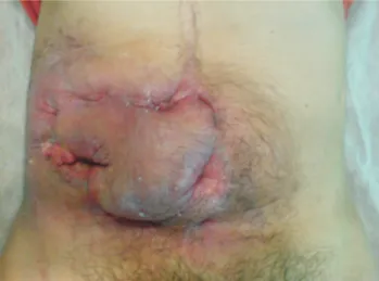 Figura 4 - Aspecto da cicatrização após reindução do tratamento com ADA em dose de ataque