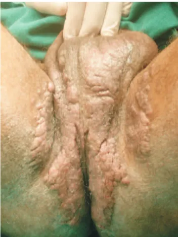 Figura 2 - Lesão vegetante e exudativa em região perianal e perineal.