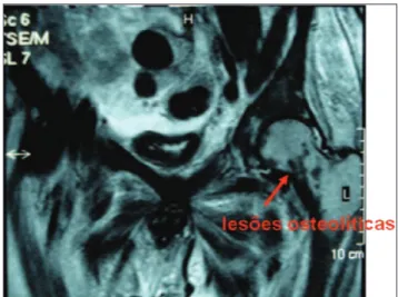 Figura  7  -  Ressonância  nuclear  magnética  evidenciando  lesões  líticas  na  cabeça  do  fêmur  (metástase óssea).