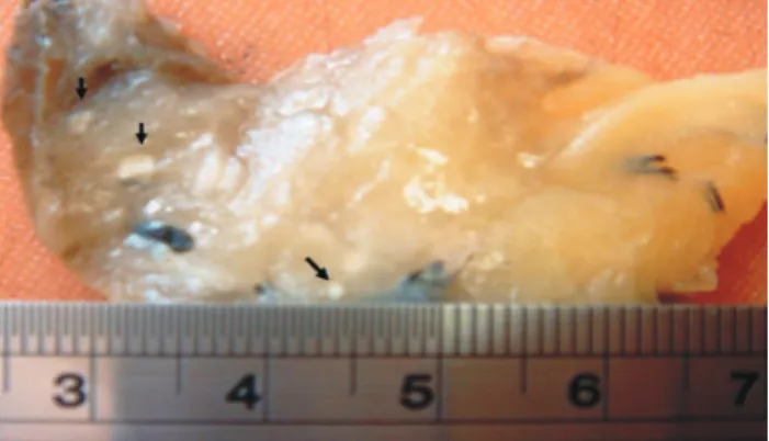Figura 1 - Tecido gorduroso do mesocólon após tratamento por solução reveladora de linfonodo, evidenciando-se linfonodos  me-nores do que 1 mm (setas).