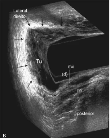Figura 1 - Pré-quimioradioterapia  – uT3 - Tumor no reto médio- médio-inferior em paciente sexo feminina, localizada no quadrante  anteri-or e lateral direito.