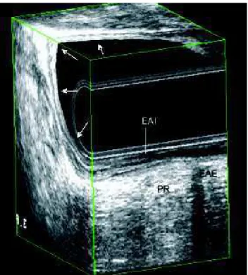 Figura 2 - Pós-quimioradioterapia – Regressão completa da le- le-são- visualização das camadas do reto no local prévio do tumor.