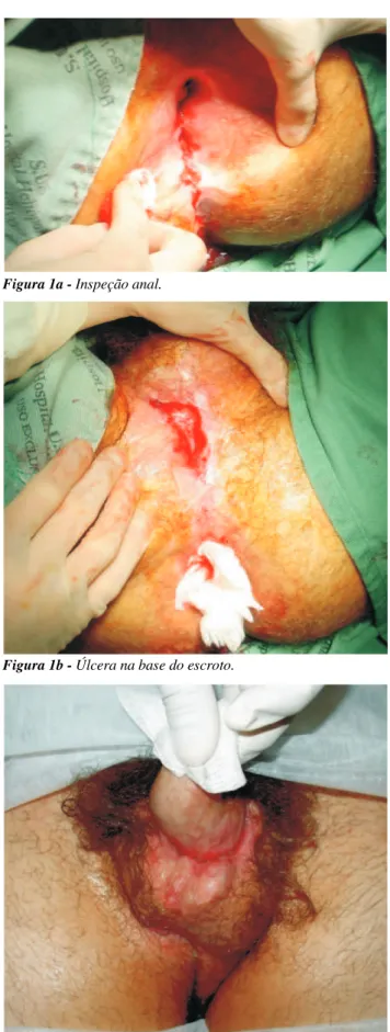 Figura 1b - Úlcera na base do escroto.