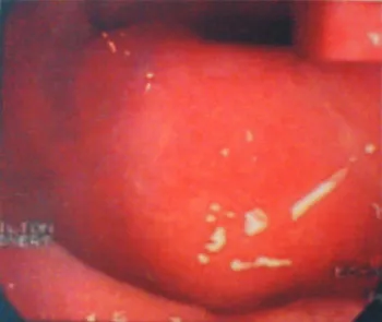 Figura 1 – Imagem colonoscópica do pólipo, indicando sua situa- situa-ção submucosa no reto.