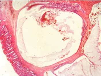 Figura 5 – Microscopia da peça cirúrgica, com visualização das lesões císticas na submucosa (pequeno aumento).