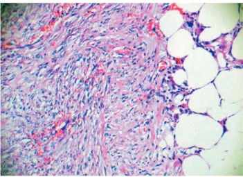 Figura 1 - Lâmina corada com hematoxilina e eosina  evidencian- evidencian-do tecievidencian-do adiposo mesenterial com grande  infiltraevidencian-do inflamatório presente na paniculite mesentérica.