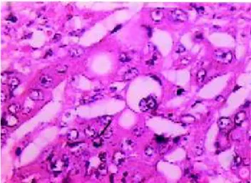 Figura 5 – Infiltração de adenocarcinoma (seta) no fígado, au- au-mento de 100x.