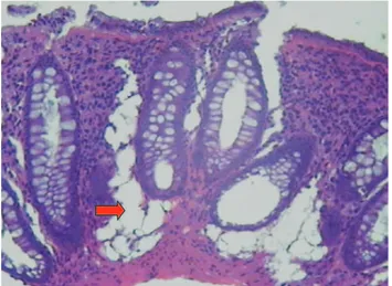 Figura 2 – Formação de vesículas nas camadas mucosa e submucosa da parede cólica - seta (HE-400x).