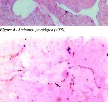 Figura 2 – Ressecção do tumor.