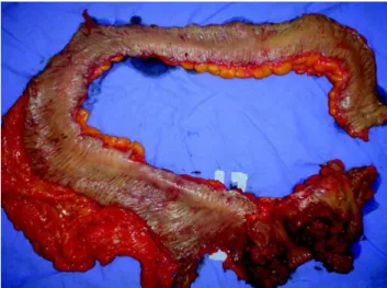Figura 4 - Peça cirúrgica de proctocolectomia, com tumoração em reto e polipose.