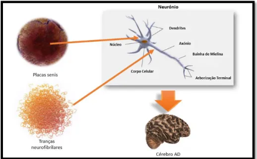 Figura 1: Deposição de placas beta senis e tranças neurofibrilares. A figura representa as duas principais evidências  patológicas associadas à doença de Alzheimer, nomeadamente as placas senis e as tranças neurofibrilares 